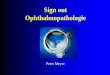 Sign out Ophthalmopathologie - WordPress.com...Bindegewebsformation zwischen Epithel und Bowman Vom Limbus her zentripetal • Degenerativ: besonders in Augen mit absolutem Glaukom,