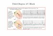 Third Degree AV Block - Thai Heart · 2012-11-23 · Third degree AV block (Complete Heart Block) • EKG –P w eva และ QRS complexes ไม สัมพันธ กัน