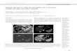Imagen del mes: Lesión focal hepática en el cirrótico ...gastrolat.org/DOI/PDF/10.0716/gastrolat2019n1000.06.pdf · caracteres de hepatocarcinoma (HCC) multifocal versus mixto