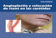 Angioplastia y colocación de stent en las carótidas (PDF) · Su problema en la arteria carótida Las arterias carótidas son vasos sanguíneos en el cuello que transpor tan la sangre