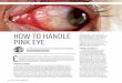 HOW TO HANDLE PINK EYE...TREATMENT Palliative treatment has been the mainstay of care for viral conjuncti-vitis for decades. It typically consists of cool compresses, artificial tears,