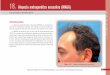 18.lopecia androgenética masculina (MAGA)ALa dosis de 1 mg día detiene la pro-gresión de la alopecia en el 90% y produce recrecimiento en el 50% de los casos. El efecto máximo