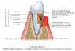Patologia dinților: Malformațiile congenitale. Leziunile carioase si … · 2020. 9. 1. · Creştereaţesutuluiconjunctiv la nivelul pulpei dentare. 2. Infiltrat celular inflamator