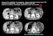 Femme de 42, antécédents de myomectomie . Douleurs …onclepaul.fr/wp-content/uploads/2011/07/corps-étrangers... · 2014. 10. 7. · tube digestif est de difficulté variable 