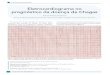 Eletrocardiograma no prognóstico da doença de Chagas...O ecocardiograma revelou dilatação das 4 câmaras, hipo-contratilidade do ventrículo esquerdo (fração de ejeção = 30%)
