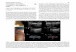 Sinusoidal Hemangioma: Correlation Between Ultrasound and 