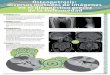 Osteopetrosis: diversos métodos de imágenes en el 
