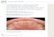 Rehabilitación adhesiva oral completa de una dentición 